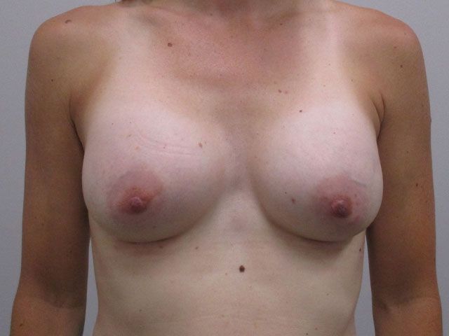 Breast Augmentation Before & After
