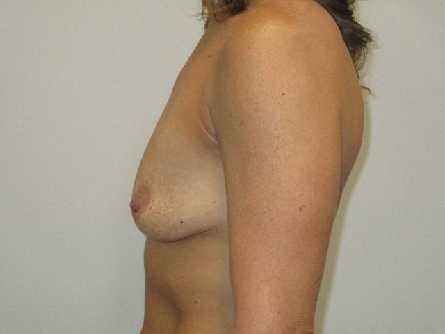Breast Augmentation Before & After