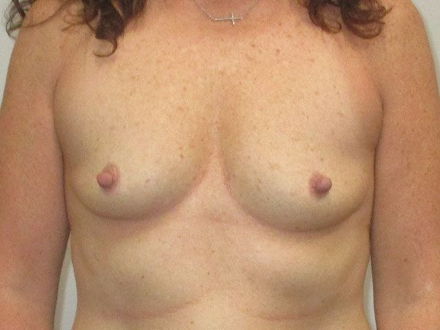 Breast Augmentation Before & After