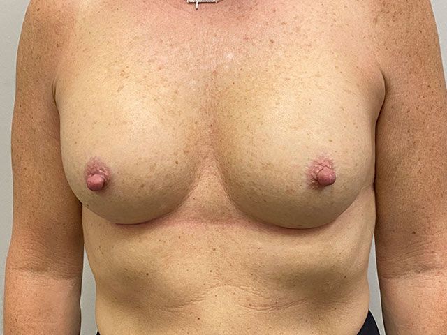 Breast Augmentation Before & After