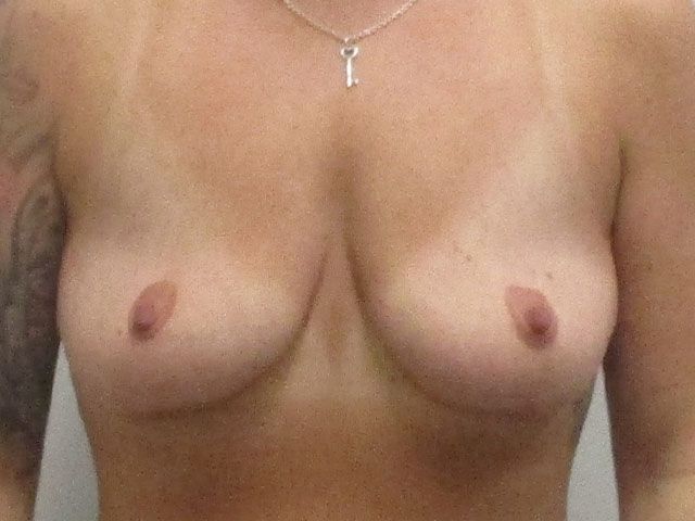Breast Augmentation Before & After