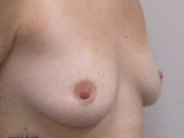 Breast Augmentation Before & After
