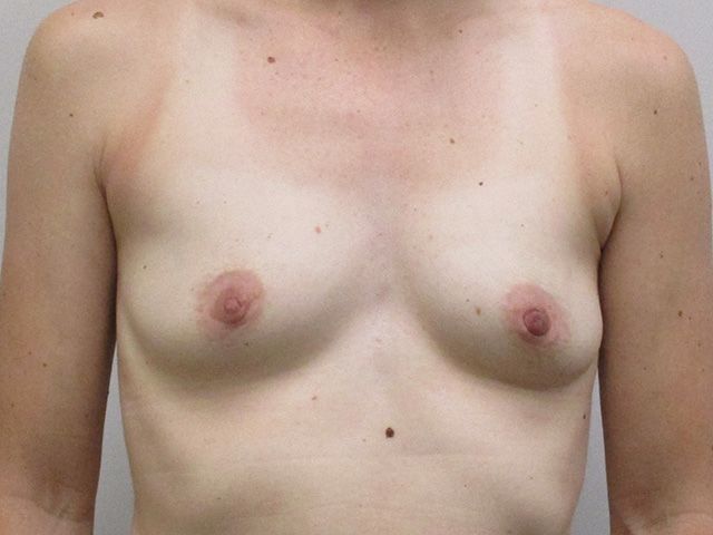 Breast Augmentation Before & After