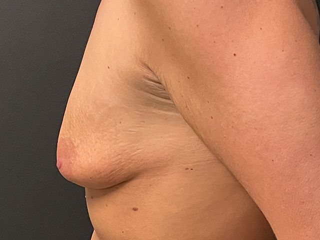 Breast Augmentation Before & After