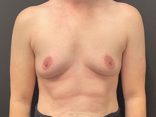 Breast Augmentation Before & After