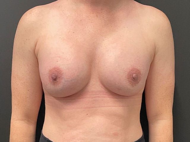 Breast Augmentation Before & After