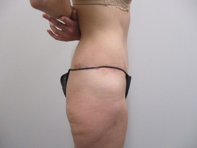 Abdominoplasty Before & After