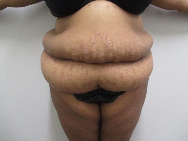 Abdominoplasty Before & After