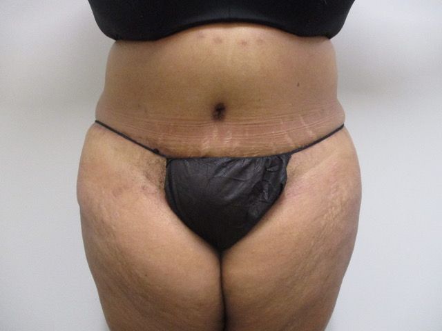 Abdominoplasty Before & After