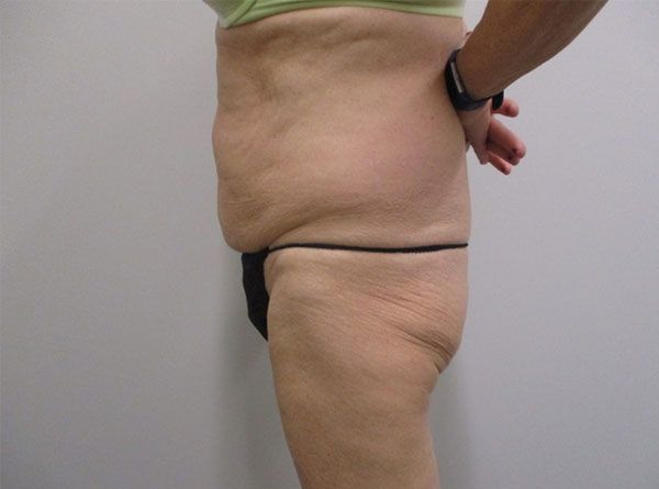 Abdominoplasty Before & After