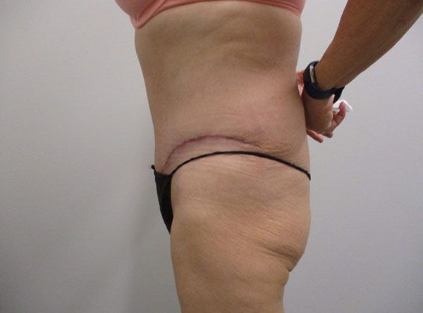 Abdominoplasty Before & After