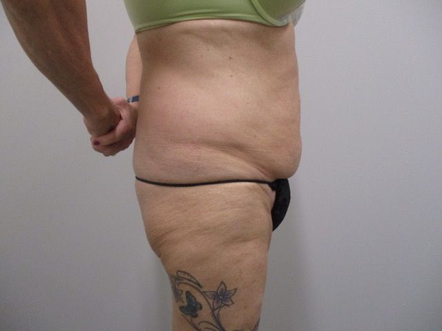 Abdominoplasty Before & After