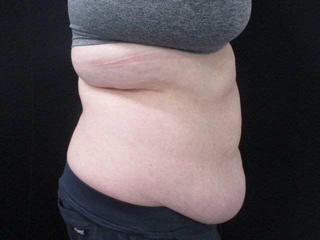 Abdominoplasty Before & After