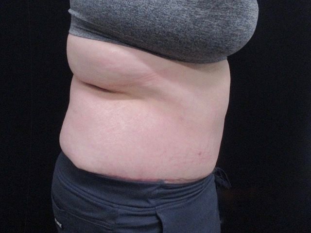 Abdominoplasty Before & After