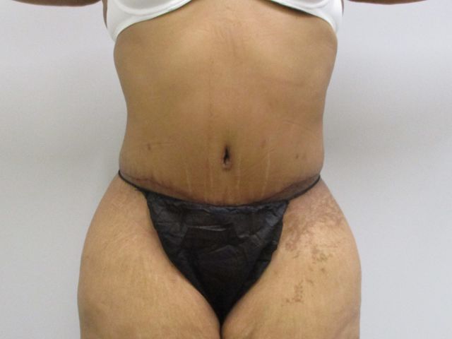Abdominoplasty Before & After