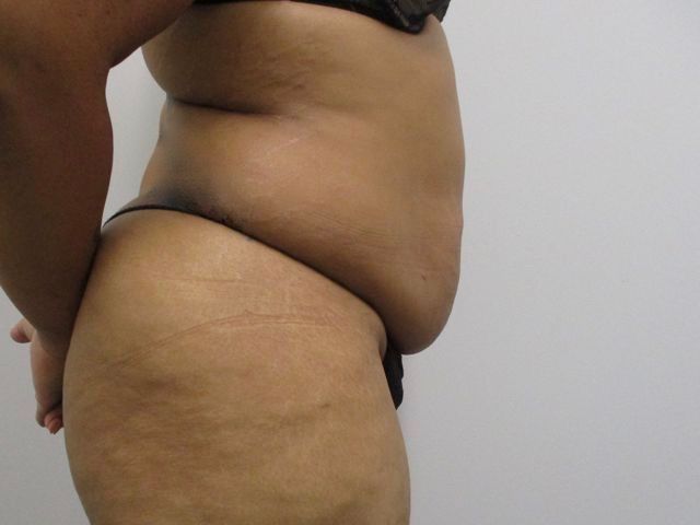 Abdominoplasty Before & After