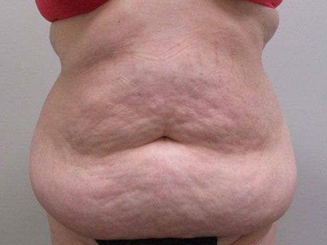 Abdominoplasty Before & After
