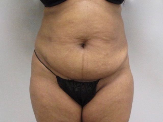 Abdominoplasty Before & After