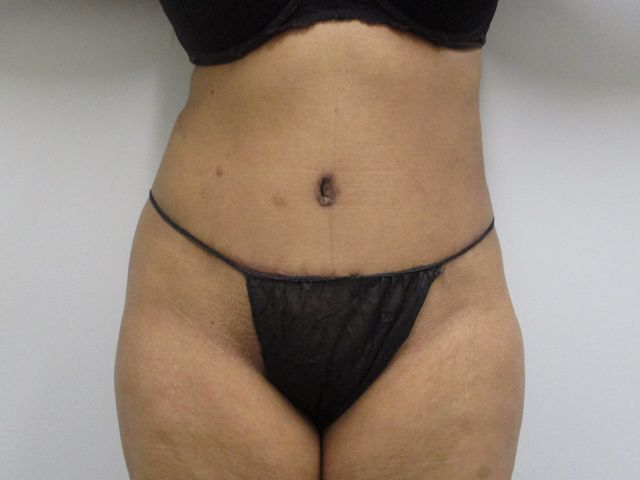 Abdominoplasty Before & After