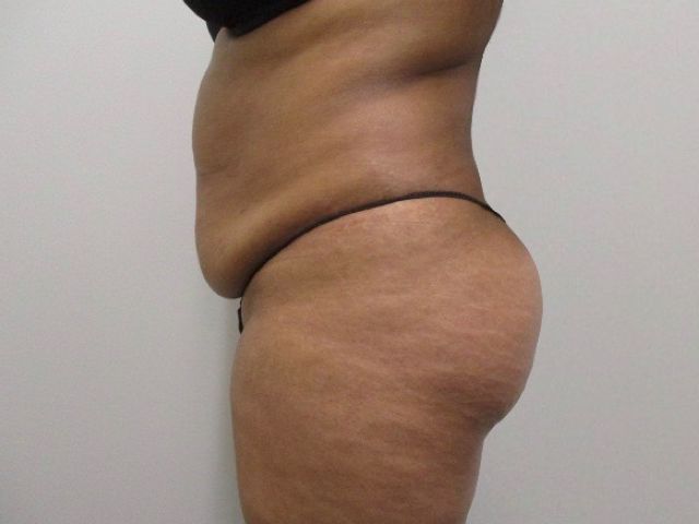 Abdominoplasty Before & After