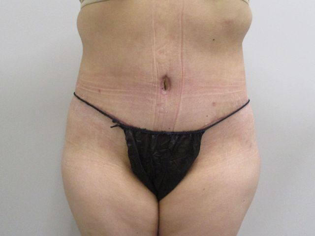 Abdominoplasty Before & After