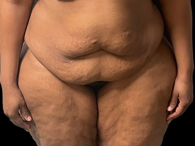 Abdominoplasty Before & After