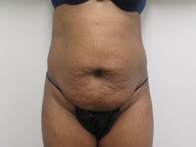 Abdominoplasty Before & After