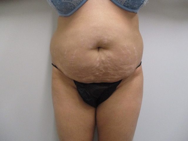 Abdominoplasty Before & After
