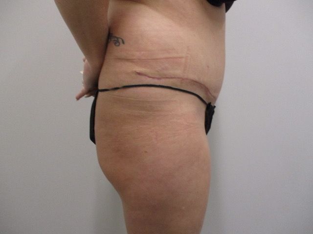 Abdominoplasty Before & After