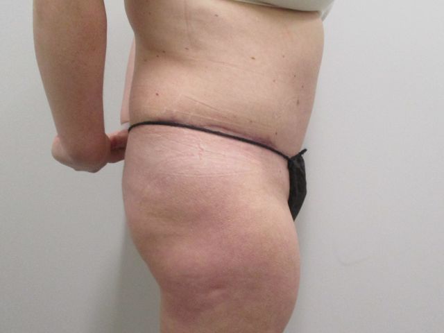 Abdominoplasty Before & After