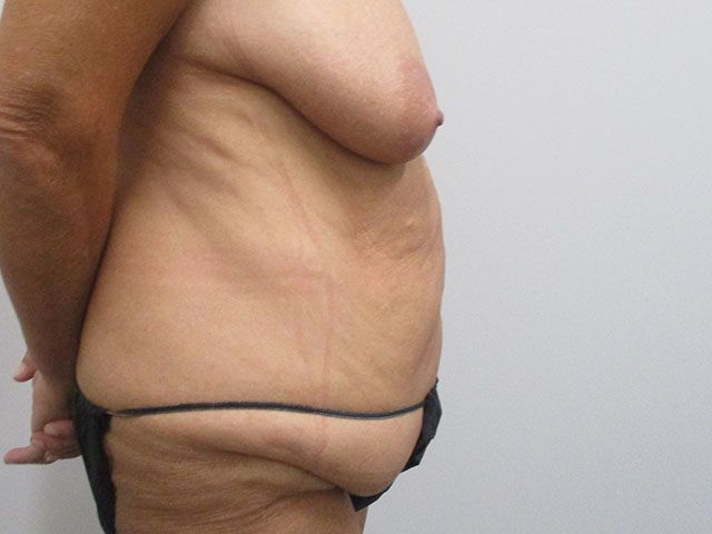 Abdominoplasty Before & After