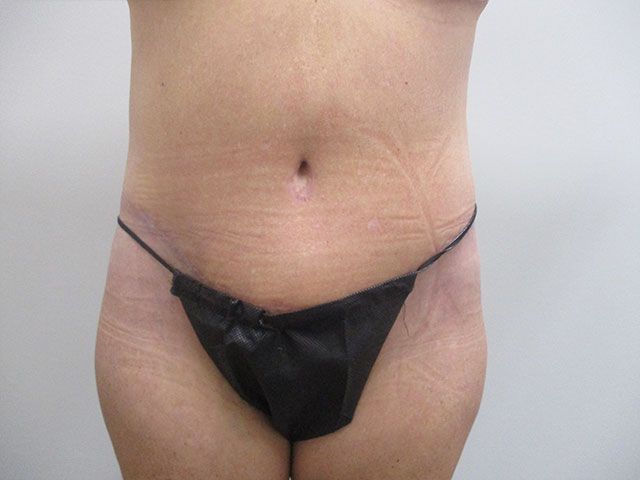 Abdominoplasty Before & After