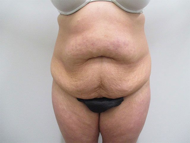 Abdominoplasty Before & After