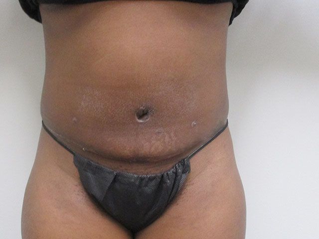 Abdominoplasty Before & After