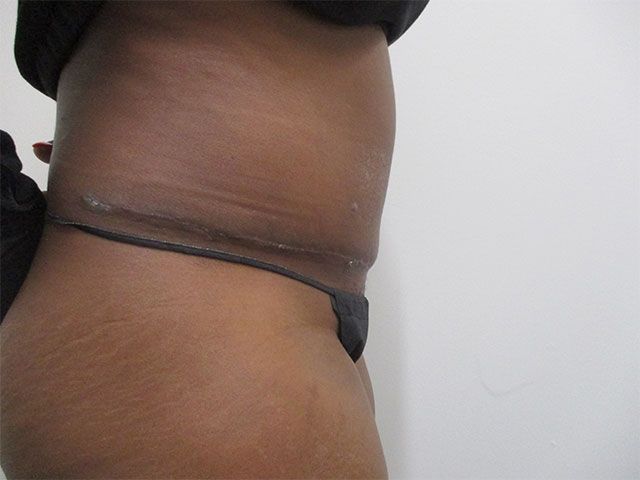 Abdominoplasty Before & After