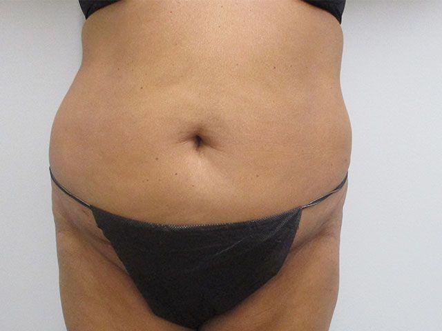 Abdominoplasty Before & After