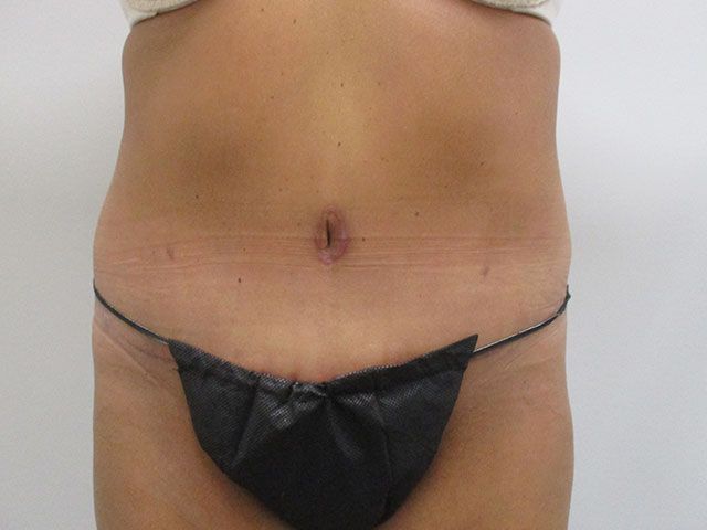 Abdominoplasty Before & After