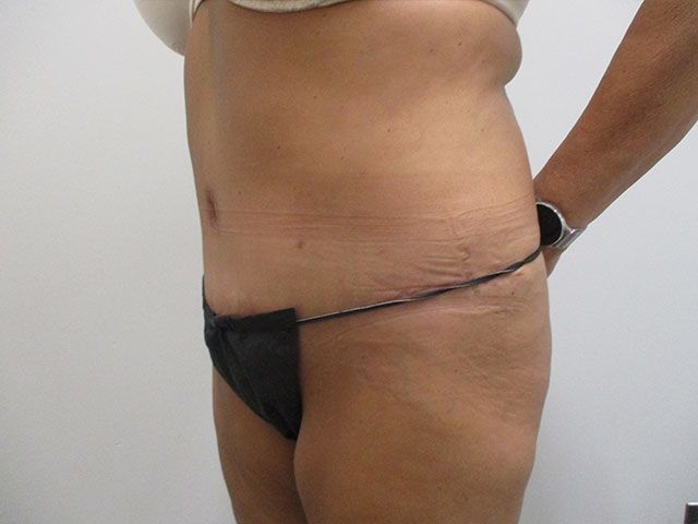 Abdominoplasty Before & After