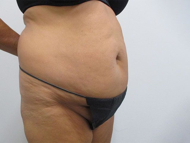 Abdominoplasty Before & After