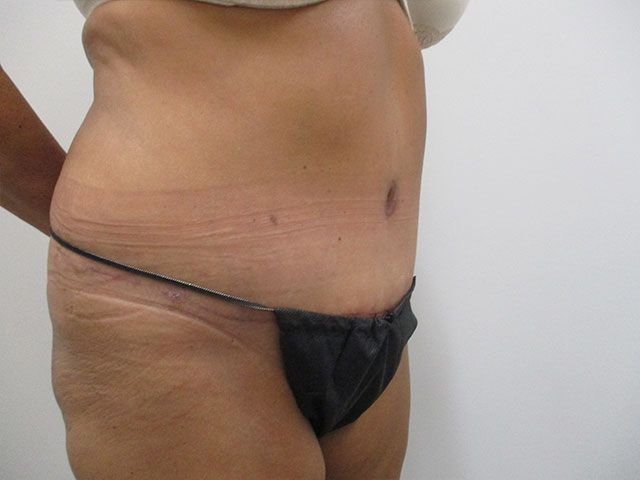 Abdominoplasty Before & After