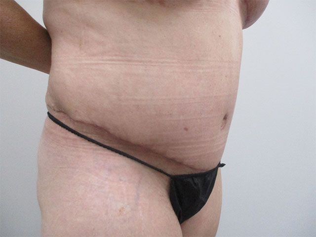 Abdominoplasty Before & After
