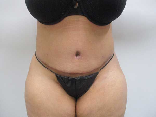 Abdominoplasty Before & After