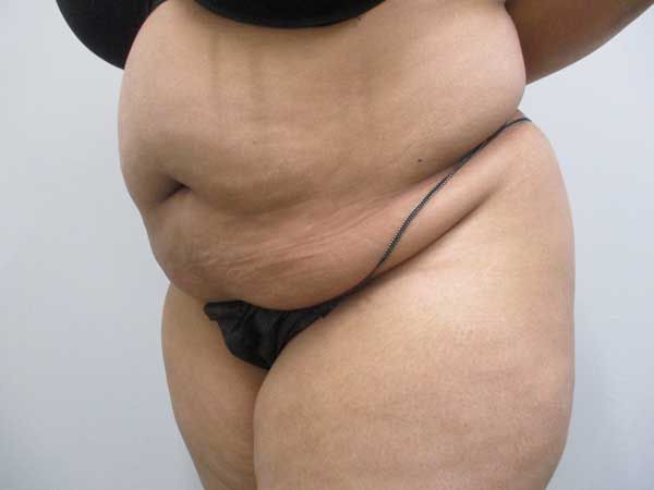Abdominoplasty Before & After