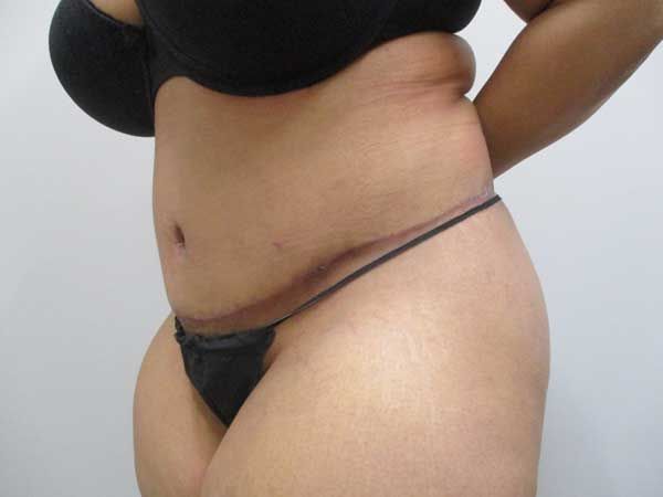 Abdominoplasty Before & After
