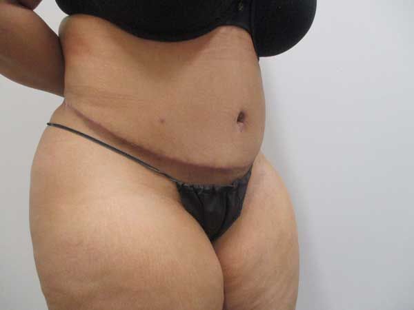 Abdominoplasty Before & After