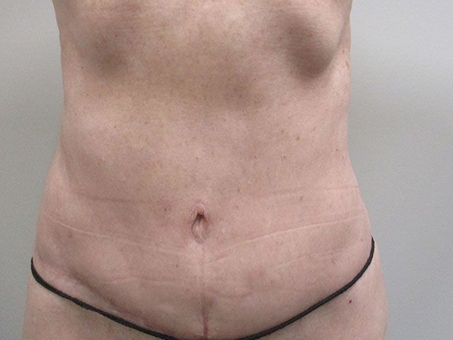 Abdominoplasty Before & After