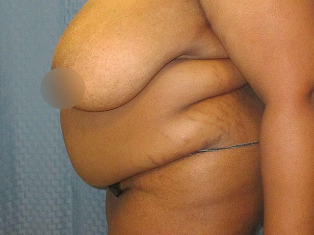 Abdominoplasty Before & After