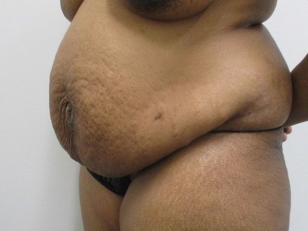 Abdominoplasty Before & After