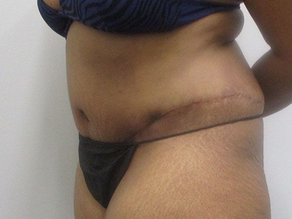 Abdominoplasty Before & After