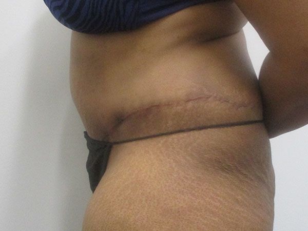 Abdominoplasty Before & After